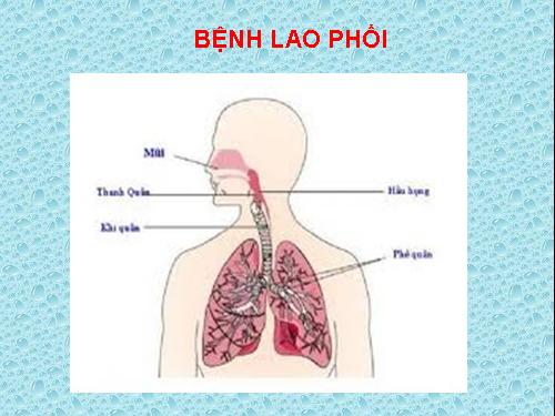 Bài 5. Bệnh lao phổi