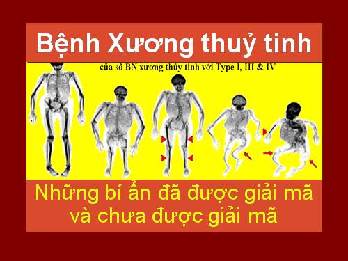 Bệnh xương thủy tinh.