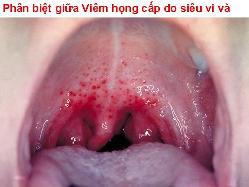 BỆNH VIÊM HỌNG CẤP.