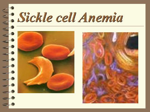 Sickle cell Anemia