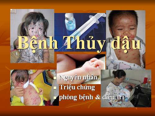 Bệnh Thủy đậu