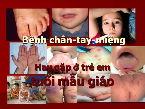 Bệnh chân tay miệng của trẻ em