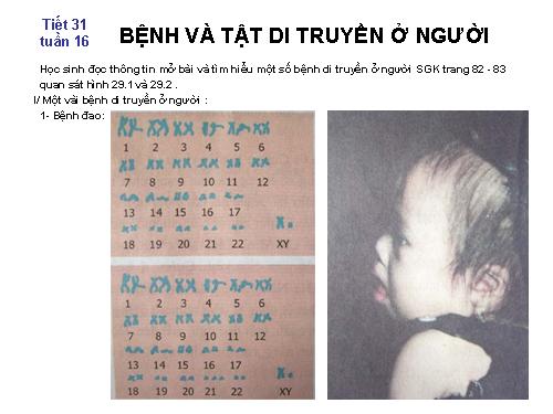 Bài 29. Bệnh và tật di truyền ở người